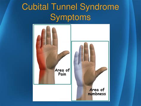 Cubital Tunnel Syndrome Definition Symptoms Causes Images