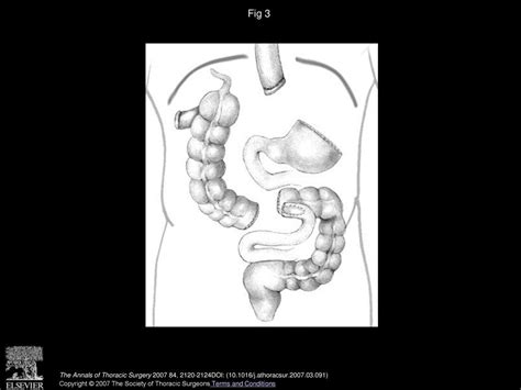 Laparoscopic And Thoracoscopic Ivor Lewis Esophagectomy With Colonic