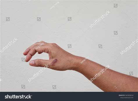 Womans Hand Scalded Hot Water Scalds Stock Photo Shutterstock