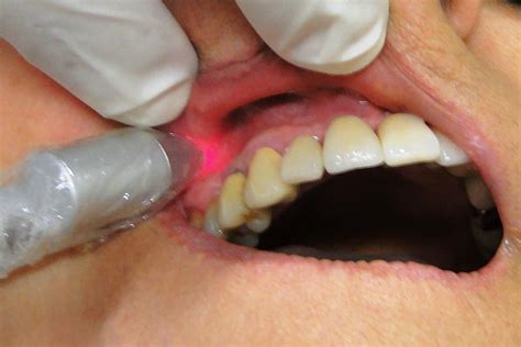 Low Level Laser Therapy In Dentistry Alux Dental