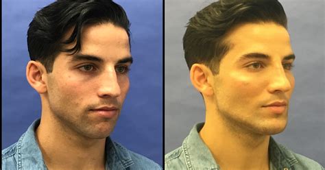 Men Attracted To Plastic Surgery From Torso Tucks To Hair Transplants