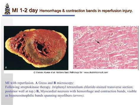 Myocardial Infarction