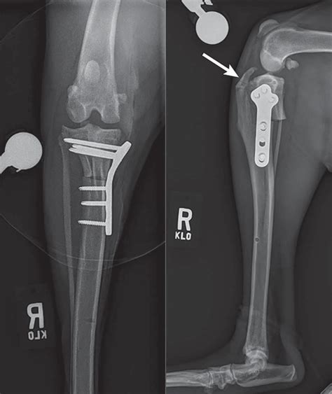 Common Tibial Plateau-Leveling Osteotomy Complications | Clinician's Brief