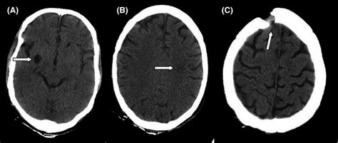 Computed Tomography Ct Scans Of The Brain Of The Patient A Download Scientific Diagram