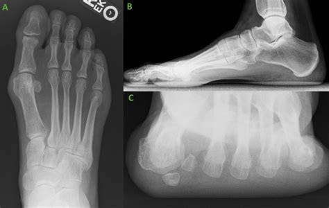Ossiofiber® Compression Screw Fixation For Intercuneiform Instability