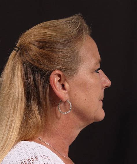 Neck Rejuvenation - Profile MD