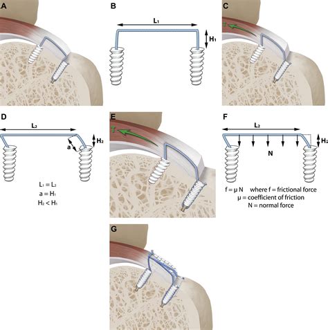 The Evolution Of Suture Anchors In Arthroscopic Rotator Cuff Repair