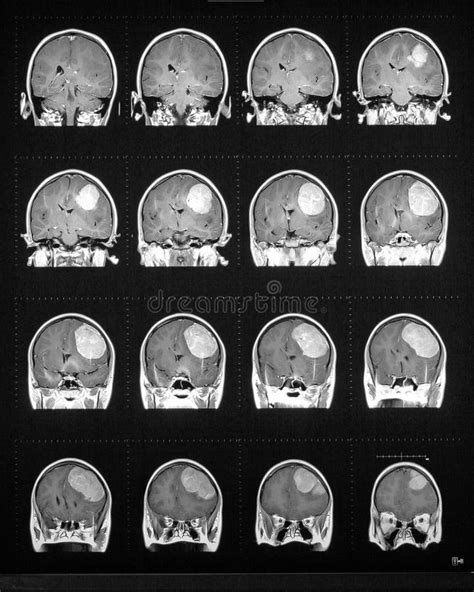 Tumor Cerebral Imagem De Stock Imagem De C Ncer Parietal