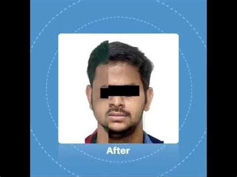 growth   upper jaw hypoplastic maxilla youtube