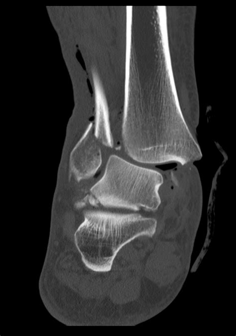 Trimalleolar Fracture Image Radiopaedia Org