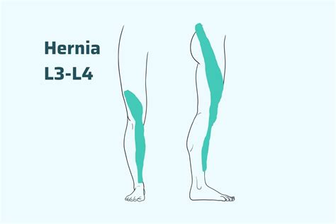 Hernia L3-L4, wat kan je eraan doen? - Herniapoli | PTED specialist