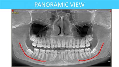 Ear Xray Ent Xray Cbct Scans Auckland New Zealand