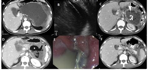 Figure From Endoscopic Ultrasound Guided Transmural Drainage Of