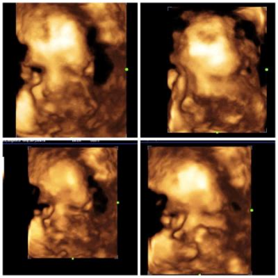 Labio Leporino Ultrassom - Labio leporino | BabyCenter