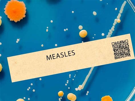 Hundreds Exposed To Measles In Ca Amid Global Uptick Health Advisory