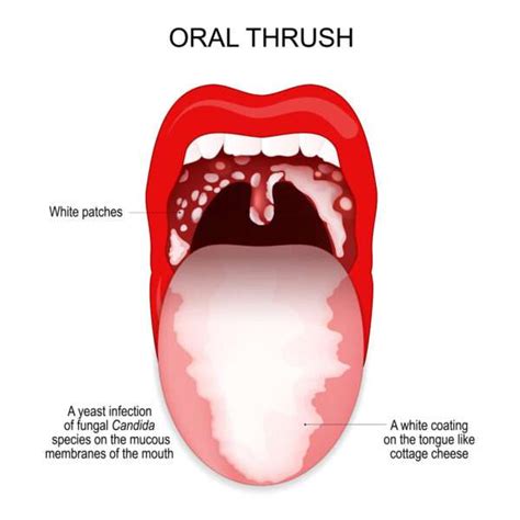 What Is Thrush In Your Mouth Top Sellers