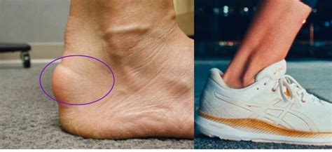 Can Shoes Cause Achilles Tendonitis Solution Shoes