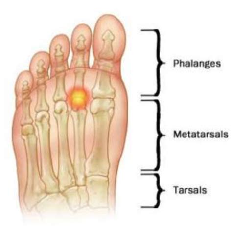 metatarsal head