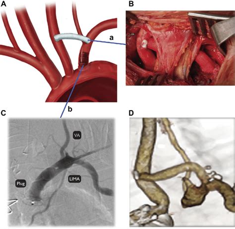 A And B In Elective Cases A Left Carotid To Subclavian Artery Bypass Download Scientific