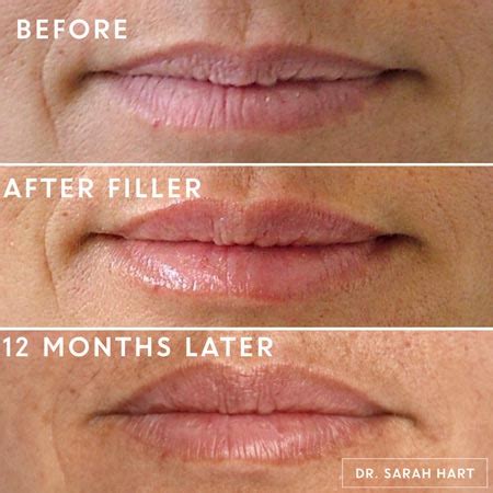 Saggy Lips From Lip Fillers Lipstutorial Org