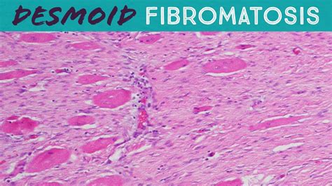 Desmoid Tumor Fibromatosis Explained In Minutes Pathology Usmle Fap