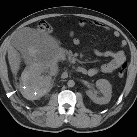 Renal Synovial Sarcoma Pacs