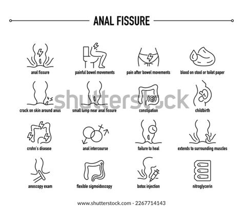 Anal Fissure Symptoms Diagnostic Treatment Vector Stock Vector Royalty Free