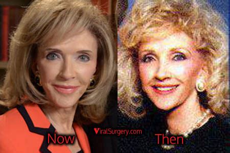 Rexella Van Impe Plastic Surgery Facelift, Before and After Pics