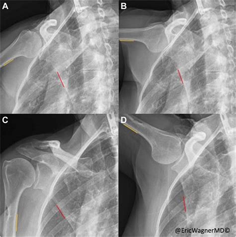 Serratus Anterior Palsy As A Masquerader Utilizing Novel Digital