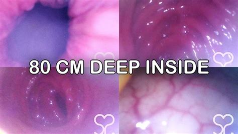 Anal Endoscope All The Way In My Transverse Colon Full Video On