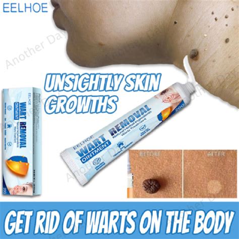 Eelhoe Warts Remover Original Cream Wart Remover Ointment Wart