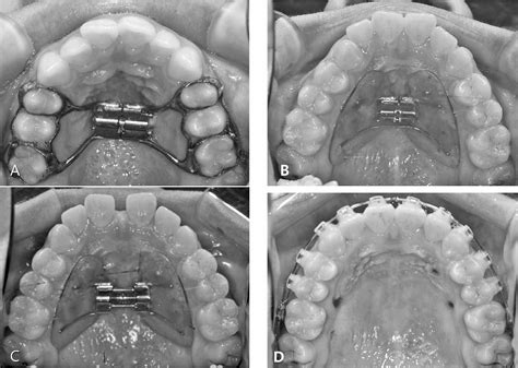 Figure 1 From Tooth Borne Vs Bone Borne Rapid Maxillary Expanders In