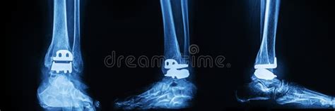 X-ray of Total Ankle Joint Arthroplasty with Prosthesis.Orthopedic and ...