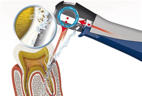 Чем лечить воспаление десен - Стоматология «НоваДэнт»