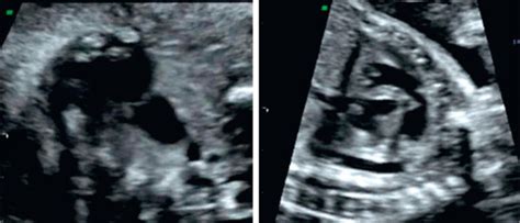 Pulmonary Stenosis And Atresia Radiology Key