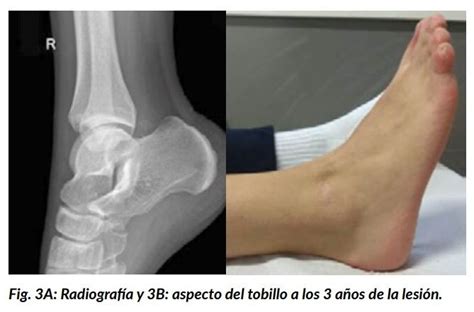 Casos Cl Nicos Somacot Sociedad Matritense De Cirug A Ortop Dica Y