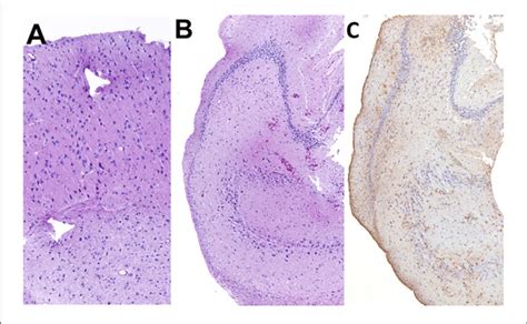 | Histopathology of the resected cortex (A) and hippocampus (B,C ...