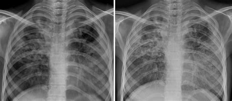 Portable Chest X Ray Images Validated In Tb Patients