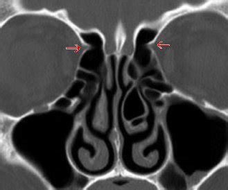 Tutorials in otolaryngology: Anatomy of anterior ethmoidal artery