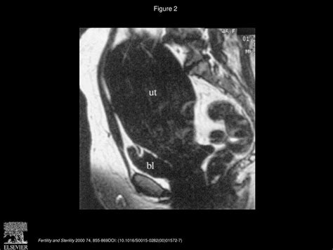 Uterine Artery Embolization For Symptomatic Uterine Myomas Ppt Download