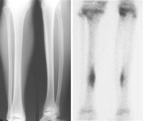 Injury Series Tibial Stress Fractures And Stress Reactions The Role