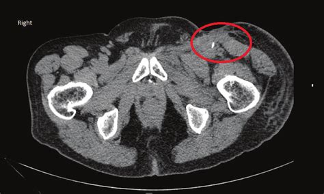 Ct Scan Of Abdomen And Pelvis Axial Image Through Inguinal Region