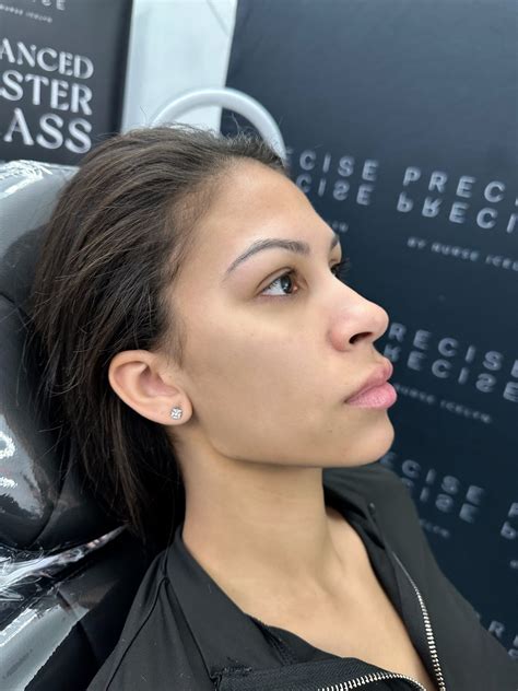 JAWLINE-TRANSFORMATIONS | Precise by Nurse Icelyn