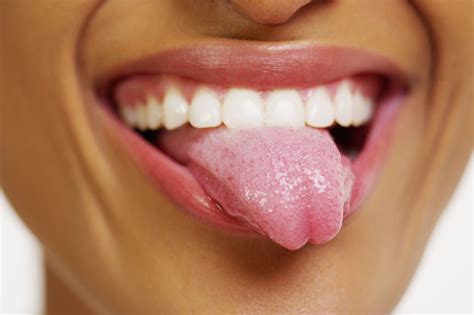 Canker Sore On Tip Of Tongue