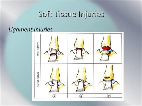 Soft Tissue Injuries