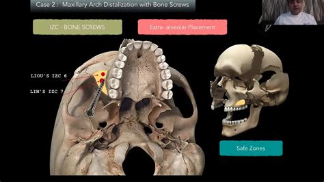 Lecture 2 Infra Zygomatic Bone Screws Izc Upper Arch