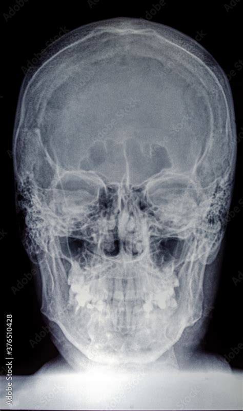 X-ray of the skull of an adult male Stock Photo | Adobe Stock
