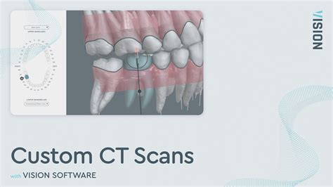 CBCT Dental Scan CBCT Analysis In VISION YouTube