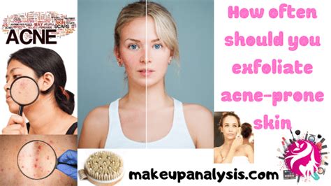 How Often Should You Exfoliate Acne Prone Skin Makeup Analysis