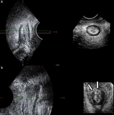 Postpartum Two‐ And Three‐dimensional Ultrasound Evaluation Of Anal Sphincter Complex In Women